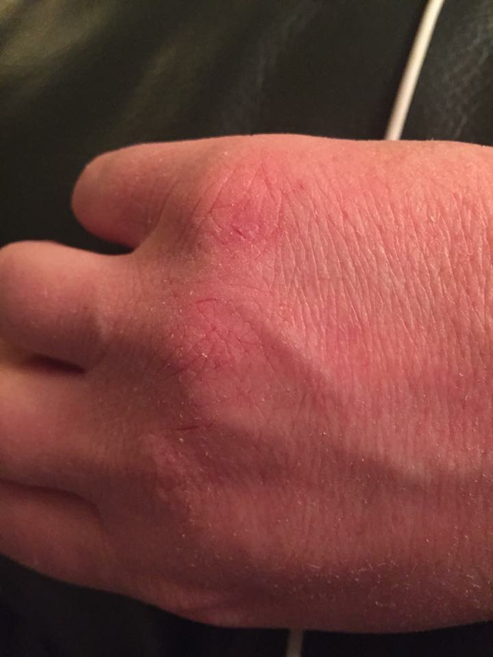 Chronic dry, red knuckles/tops of hands : r/Skincare_Addiction