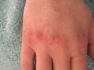 Cracked skin on hands, knuckles